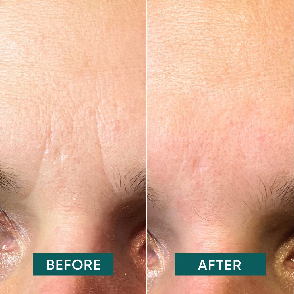 APRICOT kortsuplaastrid hüaluroonhappega laubale ja silmade vahelisele alale "Down the Frown" 100tk - Image 2