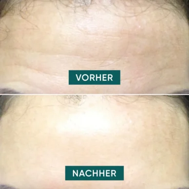 APRICOT silikoonist kortsuplaaster hüaluroonhappega otsmikule "Fantastic Forehead"  30x korduvkasutatav - Image 3