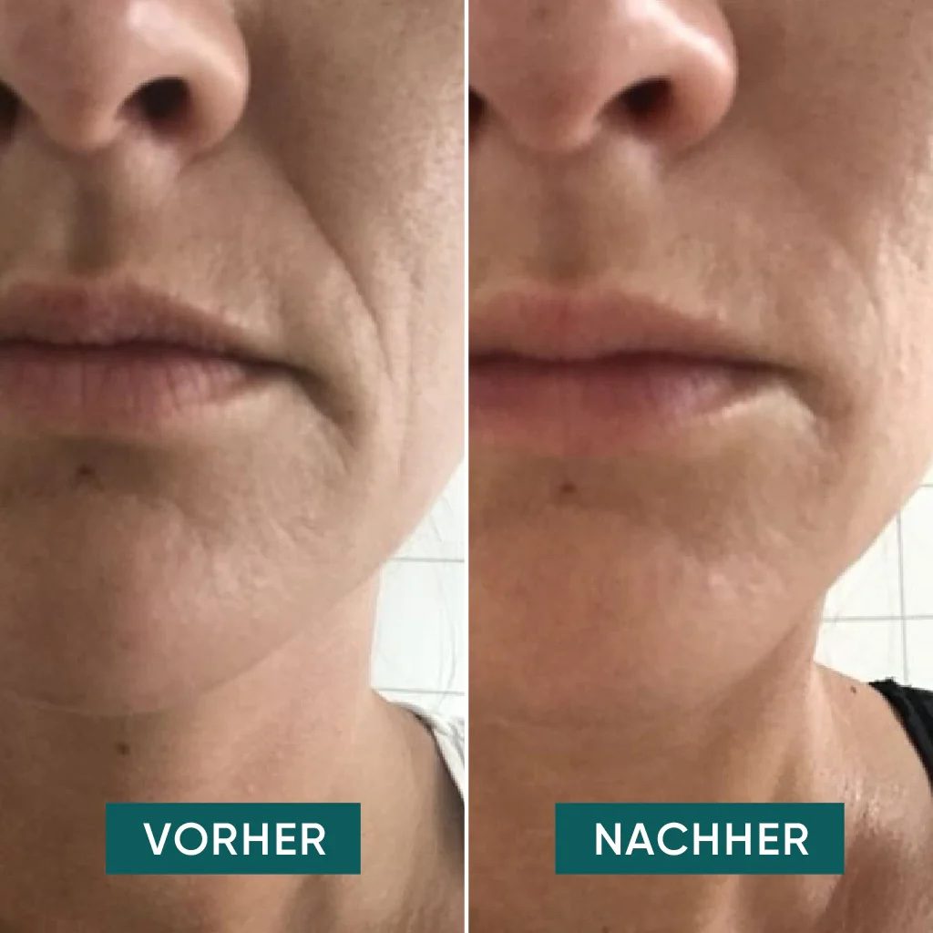 APRICOT silikoonist kortsuplaastrid hüaluroonhappega suuümbruse naerukortsudele "I Love Your Smile", 30x korduvkasutatav - Image 2