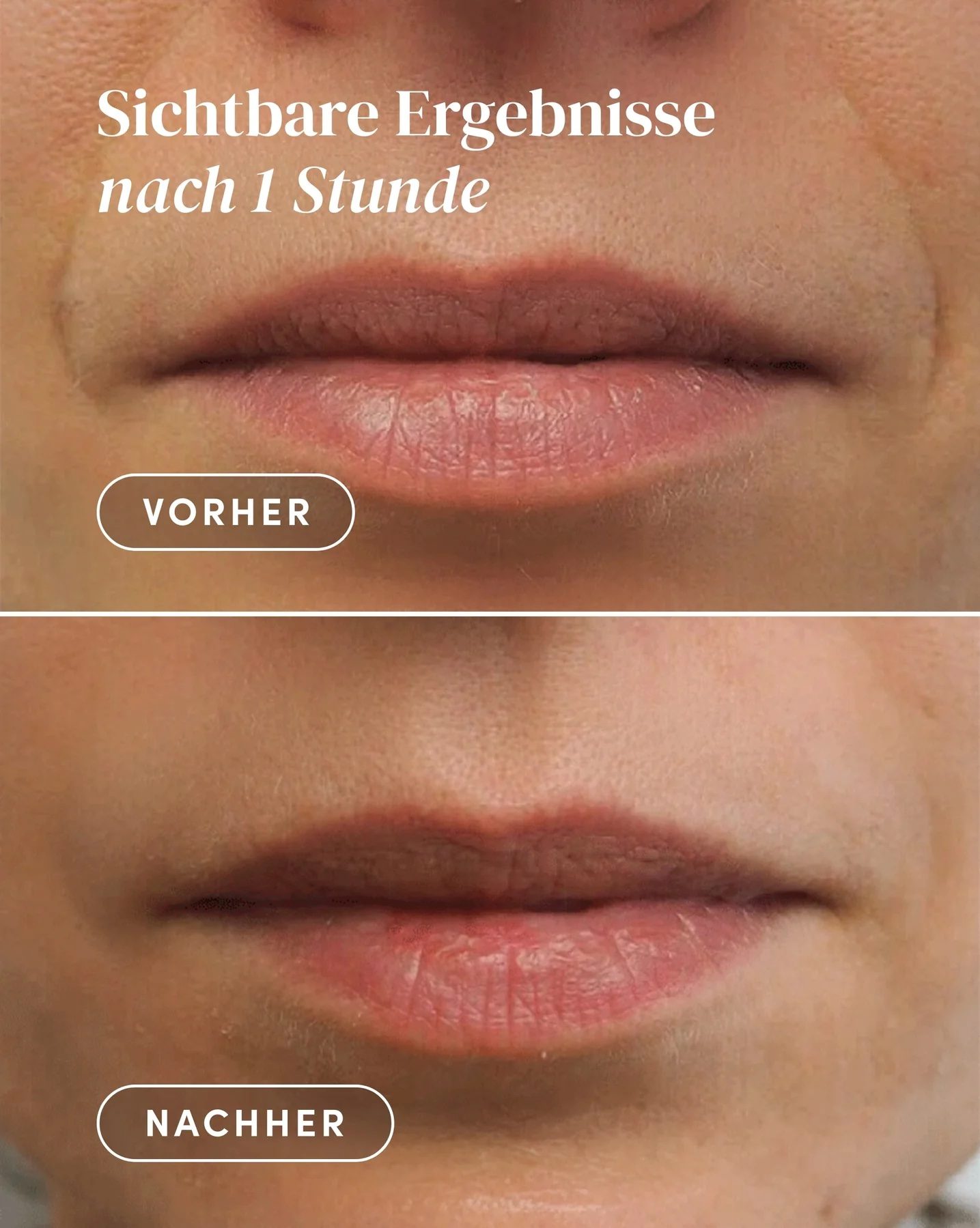 APRICOT kortsuplaastrid hüaluroonhappega suuümbruse naerukortsudele "Keep Smiling" 100tk - Image 2