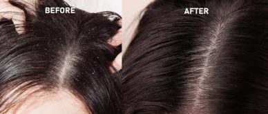 Rosinii Scalp Expert laktaathappe ja uureaga kuiva peanaha rahustav hooldus 100ml - Image 3