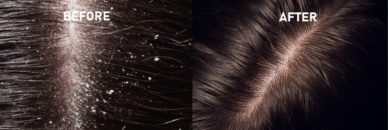 Rosinii Scalp Expert salitsüülhappe ja niatsiinamiidiga hooldus õlisele ja kõõmaga peanahale 100ml - Image 3